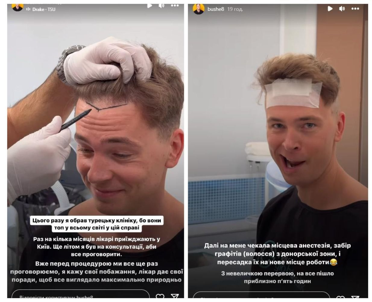 Богдан Буше розкриває весь процес пересадки волосся, стаючи прикладом сміливого рішення. 