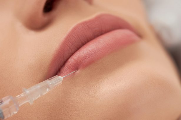 Що таке тентинг: переваги та недоліки контурної пластики губ