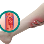 Поверхневий чи глибокий тромбоз? Дізнайтесь, як правильно розпізнати небезпечний стан.