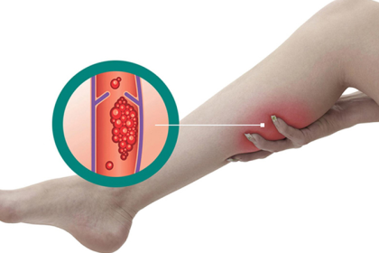 Поверхневий чи глибокий тромбоз? Дізнайтесь, як правильно розпізнати небезпечний стан.
