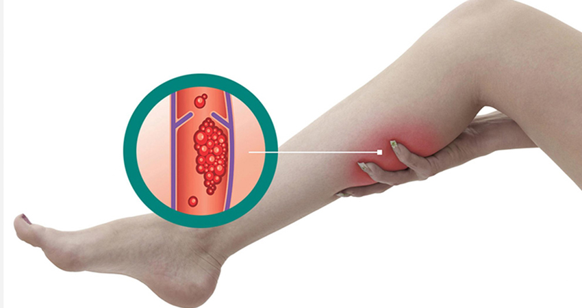 Поверхневий чи глибокий тромбоз? Дізнайтесь, як правильно розпізнати небезпечний стан.