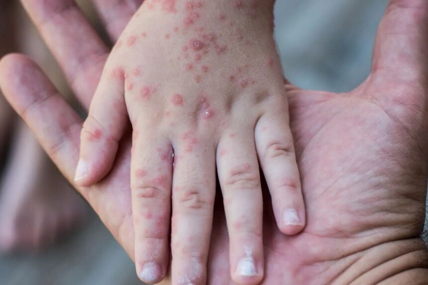 вірус коксакі у дитини як лікувати, вакцина від коксакі